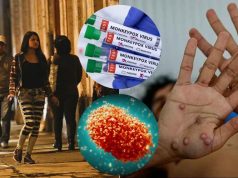La Viruela del Mono se transmite por relaciones sexuales Fase Eruptiva. Las lesiones y ampollas recién son visibles en esta segunda etapa del virus Mpox.